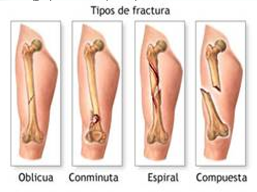 tipos de fracturas