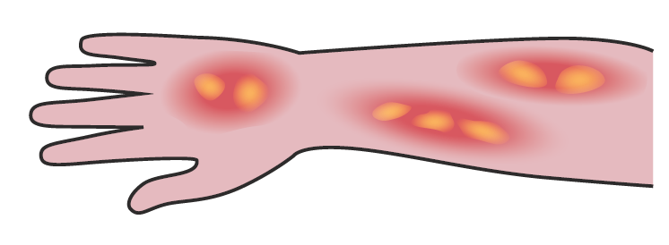 quemaduras
